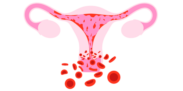 Abnormal uterine bleeding treatment in Navi Mumbai at Sattva Fertility Care Center