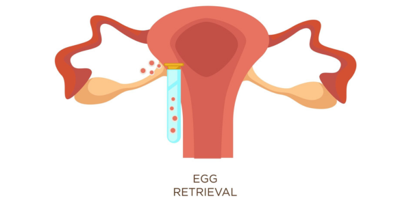 Egg retrieval procedure in Navi Mumbai at Sattva Fertility Care Center