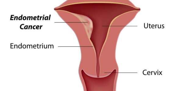 Endometrial sampling procedure in Navi Mumbai at Sattva Fertility Care Center