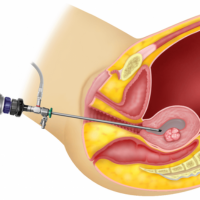 Hysteroscopy and Laparoscopy at Sattva Fertlity Care Center