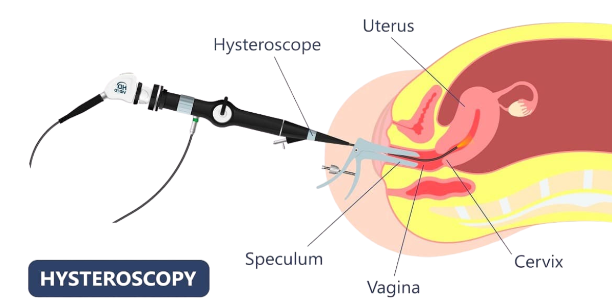 Hysteroscopy and laparoscopy surgery consultation in Navi Mumbai at Sattva Fertility Care Center